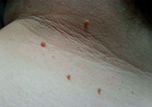 Papillomes sur le cou
